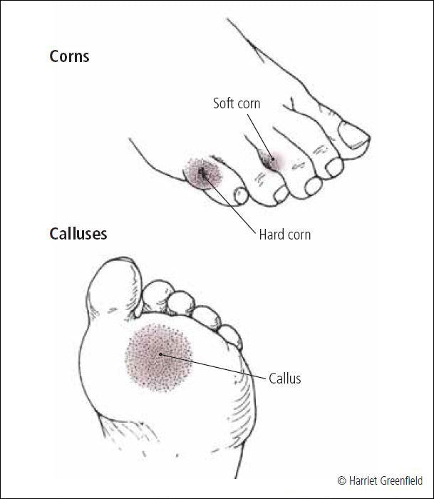 Calluses and corns